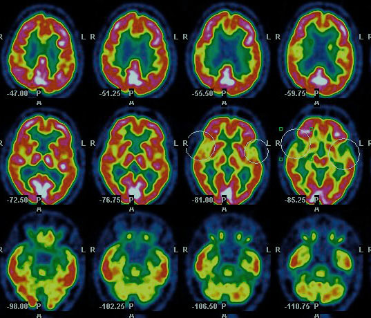 Scan of a alzheimer patient.