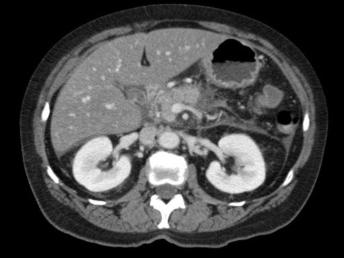 Image of CT scan of the upper torso.